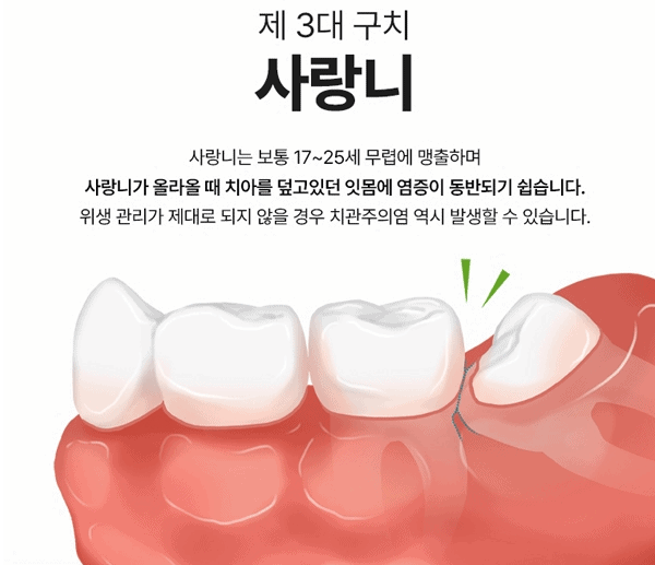 가장 안쪽에 자리한 사랑니의 위치