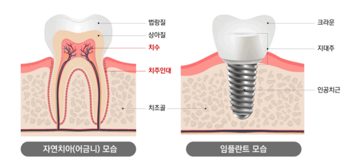 임플란트 구조를 보여주는 그림