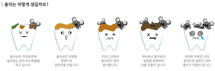 충치가 생기는 과정과 원인
