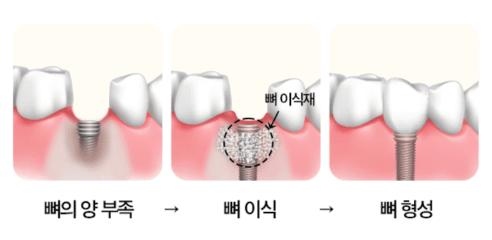 잇몸뼈가 부족할 때 진행하는 뼈이식 임플란트