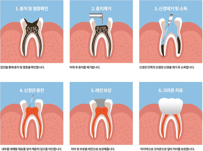 신경까지 감염된 말기 충치 치료