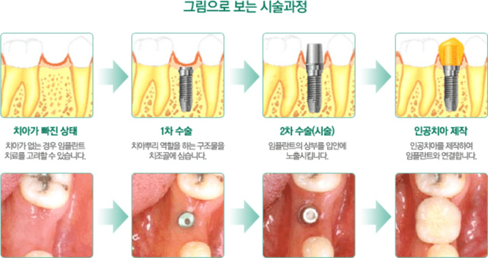 임플란트 치료가 진행되는 단계별 과정
