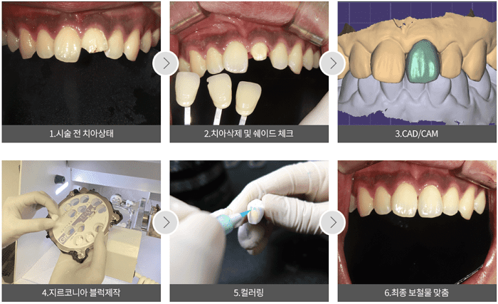 크라운 치료가 진행되는 단계